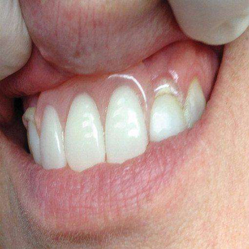 Itsoclear Molar Clasps – 2.2mm thick – 6/Pkg